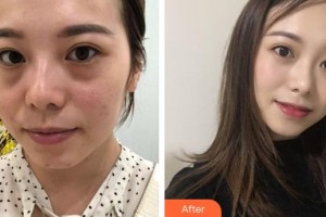 湖州愛爾眼科醫(yī)院秦士英整形價格表附激光去眼袋案例展示