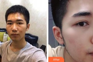 湖州愛爾眼科醫(yī)院褚惠英整形價格表附內切祛眼袋案例展示