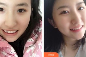 湖州鼎植口腔醫(yī)院修浩然整形價格表附牙齒隱形矯正案例展示