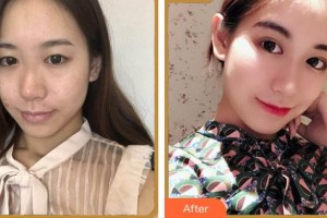 湖州長興愛爾眼科醫(yī)院雷朝霞整形價格表附眼部綜合案例展示