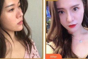 湖州長興愛爾眼科醫(yī)院陳培正整形價格表附眼部綜合案例展示