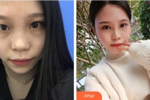 湖州長興愛爾眼科醫(yī)院金志華整形價格表附定點雙眼皮案例展示