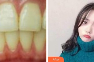 湖州鼎植口腔醫(yī)院杜文華整形價格表附冷光美白案例展示