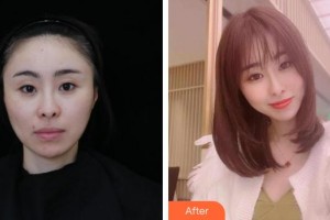 紹興華美整形美容醫(yī)院謝劍整形價(jià)格表附膠原蛋白除皺案例展示