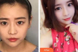 紹興華美整形美容醫(yī)院錢一佳整形價(jià)格表附熱瑪吉案例展示