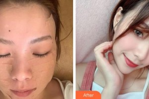 紹興市婦幼保健院醫(yī)療美容科俞國(guó)寶整形價(jià)格表附埋線提升案例展示