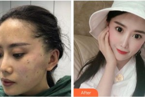 紹興陳榮法醫(yī)療整形美容診所陳榮法整形價(jià)格表附埋線提升案例展示