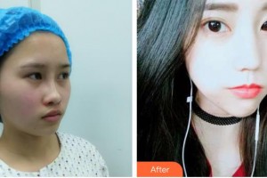 紹興華美整形美容醫(yī)院姚冬婷整形價(jià)格表附埋線提升案例展示