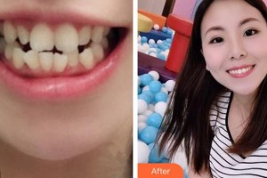 紹興市人民醫(yī)院醫(yī)療美容科王?；ㄕ蝺r(jià)格表附金屬托槽矯正案例展示