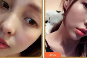 紹興市人民醫(yī)院醫(yī)療美容科徐永根整形價(jià)格表附眼鼻部手術(shù)案例展示