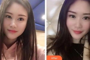 紹興市人民醫(yī)院醫(yī)療美容科阮土耿整形價(jià)格表附冷光美白案例展示