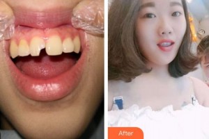 紹興越中口腔醫(yī)院高月忠整形價(jià)格表附美白貼片案例展示