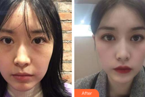 深圳美度醫(yī)療美容醫(yī)院劉玲住院醫(yī)師整形價格表附眼修復案例展示