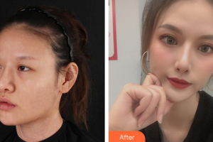 深圳美源醫(yī)療美容門診部吳曉玲整形價格表附眼部整形案例展示