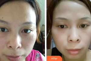 深圳賀五洲醫(yī)療美容診所黃大軍整形價格表附祛斑案例展示