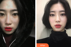 深圳賀五洲醫(yī)療美容診所賀五洲整形價格表附光子嫩膚案例展示