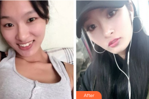 深圳賀五洲醫(yī)療美容診所胡開賢整形價格表附鼻部手術案例展示