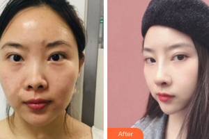 深圳美芮（原雅唯）醫(yī)療美容門診部夏超整形價格表附鼻部手術案例展示