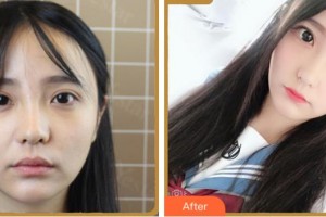 紹興愛爾眼科醫(yī)院王記紅整形價(jià)格表附眼部綜合案例展示