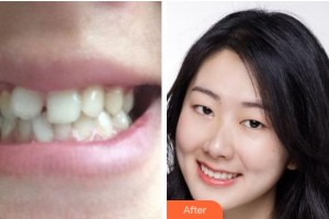 紹興越中口腔醫(yī)院鋒整形價(jià)格表附牙齒陶瓷矯正案例展示