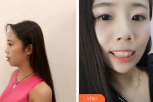 紹興越中口腔醫(yī)院朱松陽整形價(jià)格表附牙齒隱形矯正案例展示