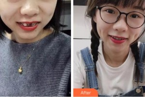 紹興市口腔醫(yī)院張侃整形價(jià)格表附金屬托槽矯正案例展示