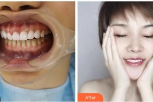 紹興京韓口腔醫(yī)院李運(yùn)科整形價格表附美白貼片案例展示