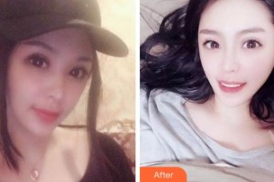 紹興德維口腔醫(yī)院潘昕整形價格表附牙齒隱形矯正案例展示