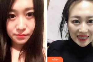 紹興德維口腔醫(yī)院邵現(xiàn)紅整形價格表附金屬托槽矯正案例展示