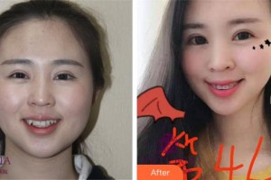 紹興柯橋口腔醫(yī)院楊學(xué)鵬整形價格表附金屬托槽矯正案例展示