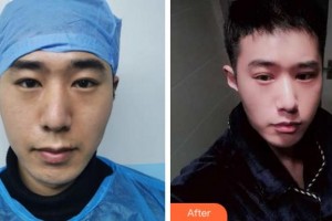 紹興袍江醫(yī)院眼科李厚碩整形價格表附眼部綜合案例展示