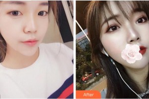 紹興袍江醫(yī)院眼科屠清安整形價格表附切開雙眼皮案例展示