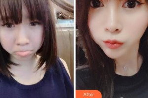 紹興袍江醫(yī)院眼科王湘娟整形價格表附眼部綜合案例展示