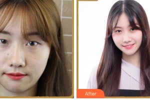 紹興市柯橋區(qū)中醫(yī)醫(yī)院眼科王潮峰整形價格表附眼部綜合案例展示