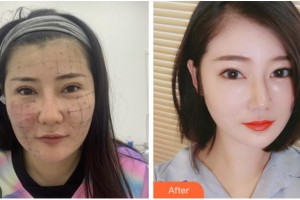 金華芘麗芙（原華美）整形醫(yī)院史頌民整形價格表附熱瑪吉案例展示