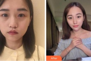 金華芘麗芙（原華美）整形醫(yī)院吳國平整形價格表附熱瑪吉案例展示