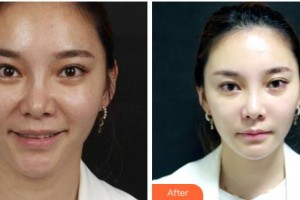 金華芘麗芙（原華美）整形醫(yī)院鄧亮整形價格表附埋線提升案例展示