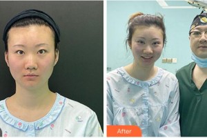 金華芘麗芙（原華美）整形醫(yī)院王敏駿整形價格表附眼部綜合案例展示