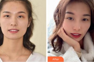 金華美辰醫(yī)療美容醫(yī)院蔡中整形價格表附牙齒隱形矯正案例展示