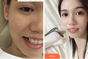 金華美辰醫(yī)療美容醫(yī)院涂強整形價格表附金屬托槽矯正案例展示