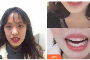 金華美辰醫(yī)療美容醫(yī)院越勇祥整形價格表附牙齒隱形矯正案例展示