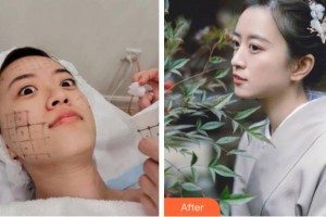 金華文榮醫(yī)院整形美容科林一奇整形價格表附熱瑪吉案例展示