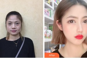 金華維多利亞美容醫(yī)院伊劍蘭整形價格表附埋線提升案例展示