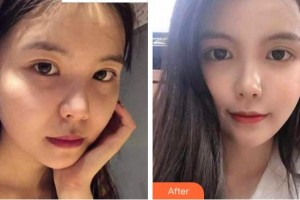 金華維多利亞美容醫(yī)院程煥武整形價格表附熱瑪吉案例展示