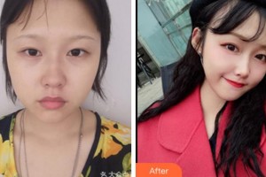 金華維多利亞美容醫(yī)院孫琦整形價格表附埋線提升案例展示