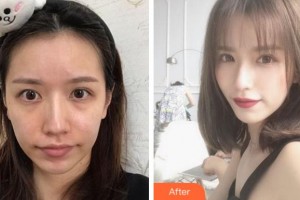 金華維多利亞美容醫(yī)院智海玲整形價格表附埋線提升案例展示