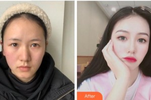 金華李丹醫(yī)療整形美容診所李丹整形價格表附雙眼皮案例展示