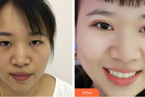 金華康美醫(yī)療美容綜合門診部劉興權整形價格表附定點雙眼皮案例展示