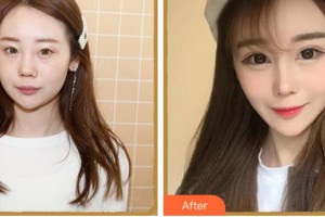 金華亞美整形美容醫(yī)院趙延嶺整形價格表附眼部綜合案例展示