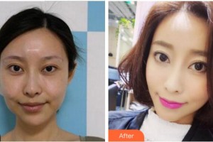 金華藝馨醫(yī)療美容門診部杜曦整形價格表附埋線提升案例展示